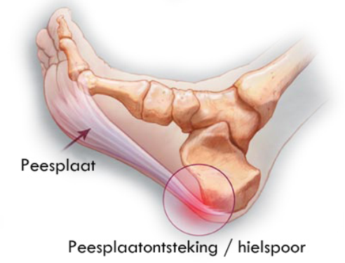 Hielpijn of peesplaatontsteking?